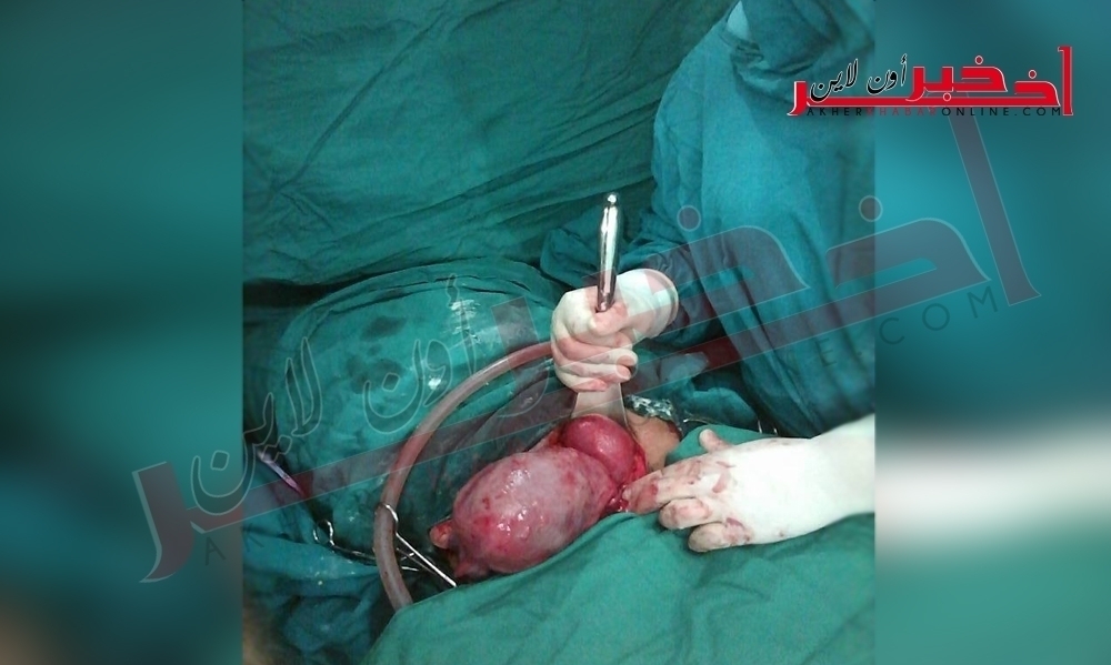  Une première Réussite d’une césarienne d’une femme à double utérus à l’hôpital de Siliana 
