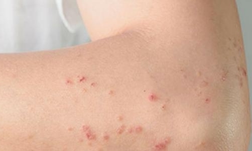 تهمّ الفئة العمريّة بين 26 و38 سنة / إنطلاق حملة التلقيح ضدّ الحصبة اليوم الإثنين